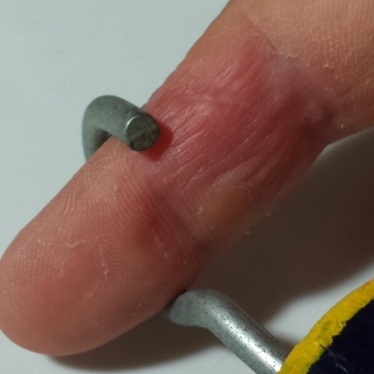 Finger looks much better now. Here pictured with the hook that caused the injury.
